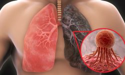 diaCancerPulmon.jpg