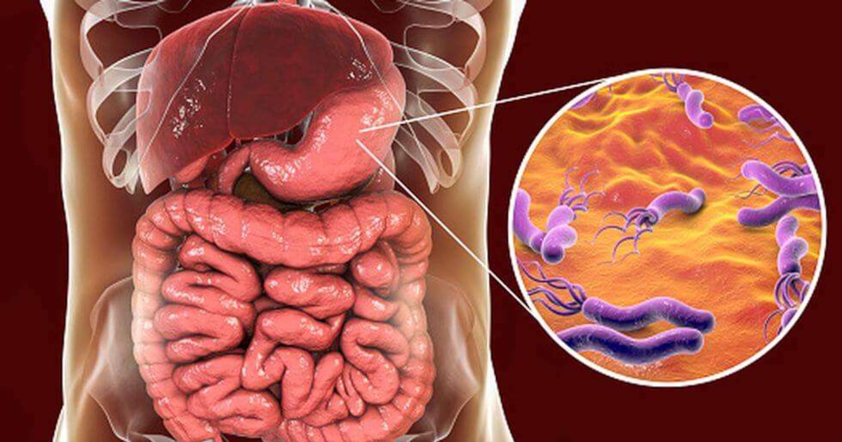 Casos de cáncer de estómago podrían aumentar por infecciones de Helicobacter pylori